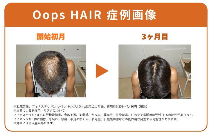 Oops HAIRの症例画像