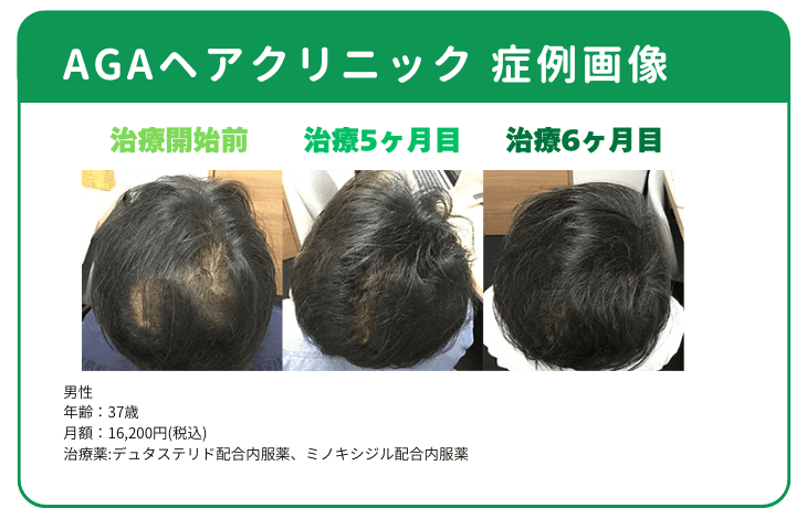 AGAヘアクリニックの症例画像